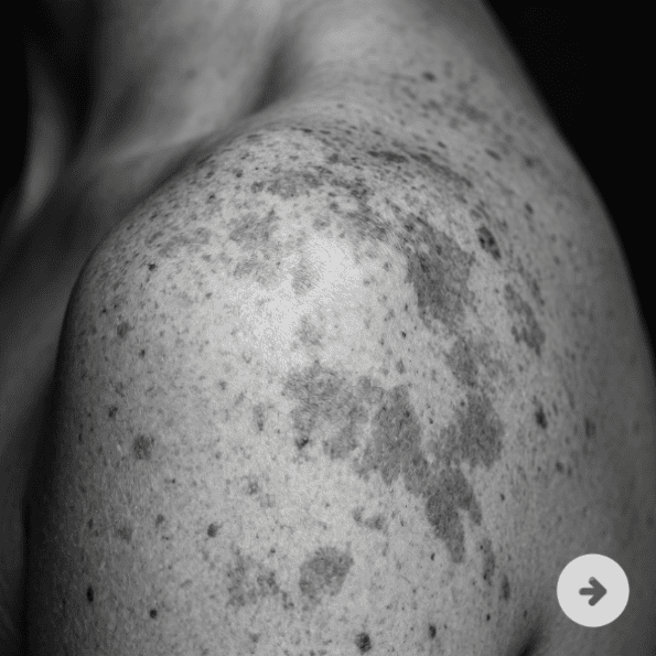 Pigmentation